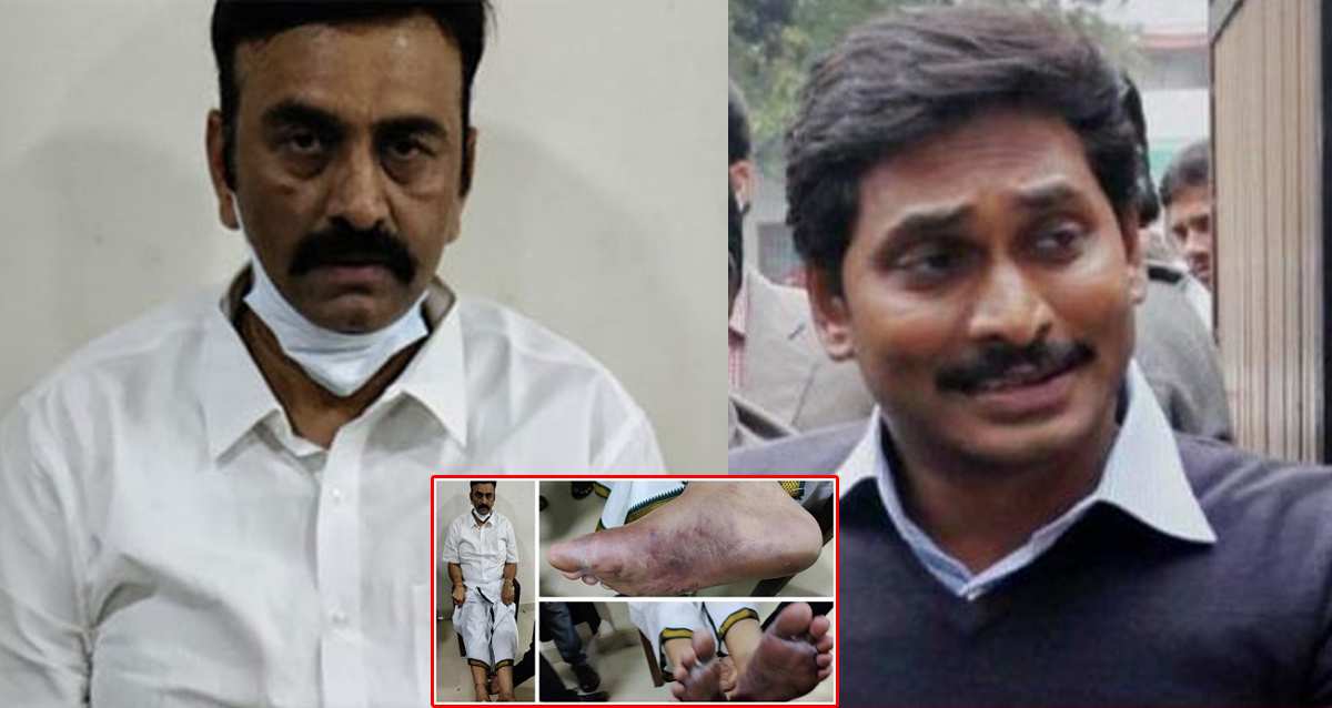 రఘురామ కృష్ణరాజు కేసులో జగన్ కి షాకింగ్ ట్విస్ట్ !  మెడికల్ బోర్డు ఏర్పాటు!