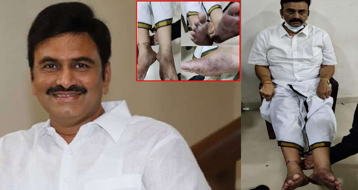 రఘురామ కృష్ణరాజు డ్రామా ఆడారా? కాలుపై ఉండేవి గాయాలు కావా?