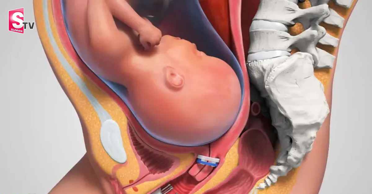ఆ శిశువు తల్లిగర్భంలోనే గర్భం దాల్చింది!..