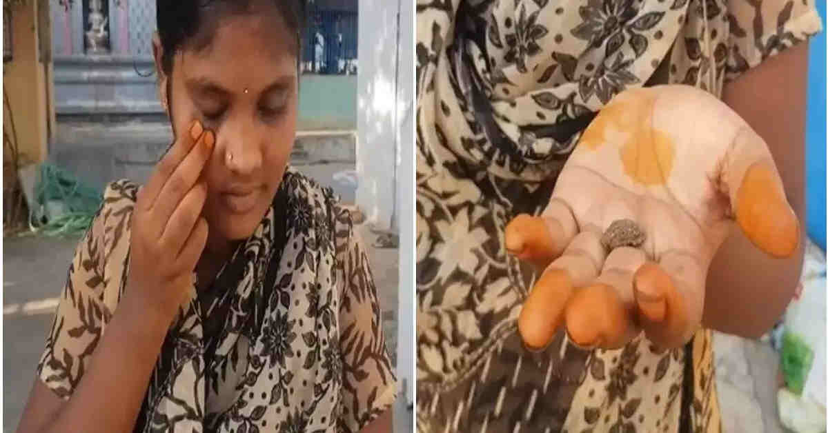 అరుదైన కంటి సమస్య- ఆమె కంట్లోంచి రాలుతున్న ఇసుక, మట్టి