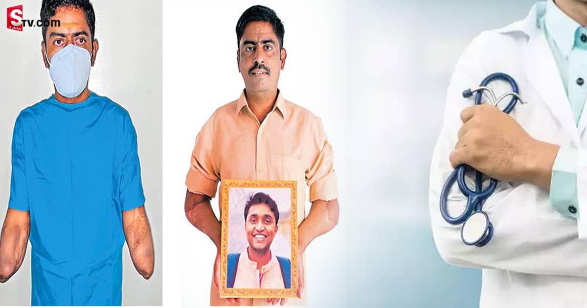 డాక్టర్స్ అద్భుతం! అవయవ మార్పిడి విధానంతో  కొత్త చేతులు!