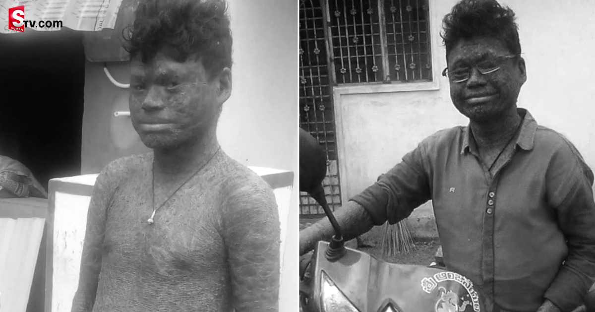 Anakapalle: ఇంటి పేరు పాము ప్రసాద్‌.. ఒంటి రంగు పాము చర్మం!