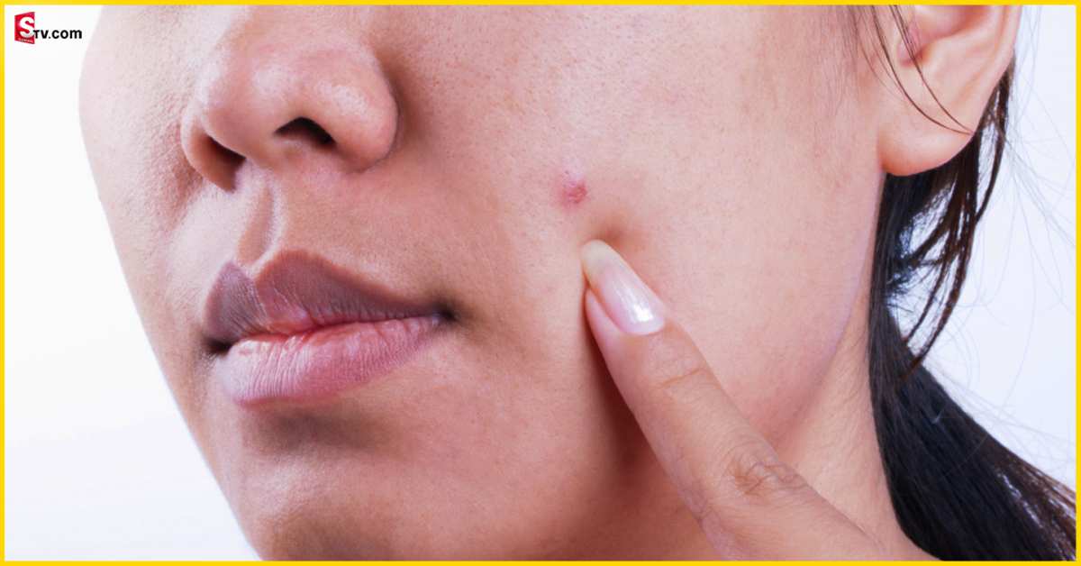 Pimples: మొహంపై మొటిమలు తగ్గడం లేదని యువతి ఆత్మహత్య!