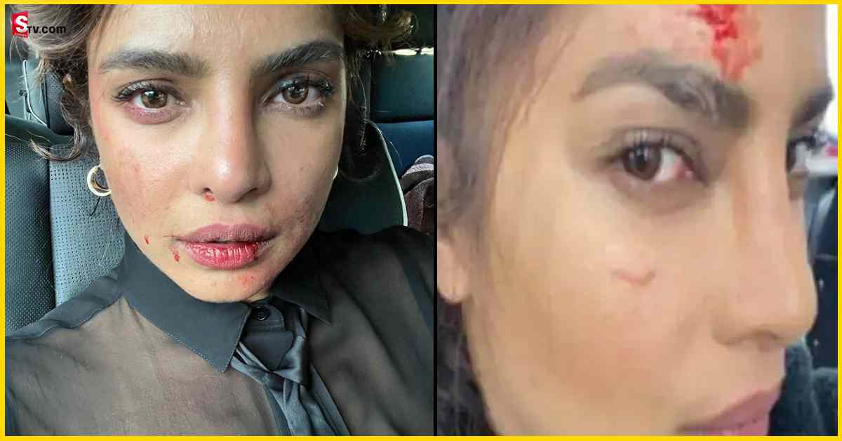 Priyanka Chopra: ప్రియాంక చోప్రాకు గాయాలు.. షాక్‌లో ఫ్యాన్స్‌