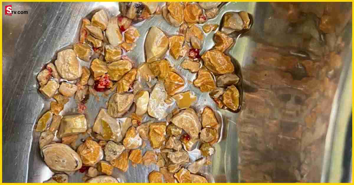 Kidney Stones: షాకింగ్‌ న్యూస్‌ : నల్గొండ వాసి కిడ్నీలో 206 రాళ్లు..