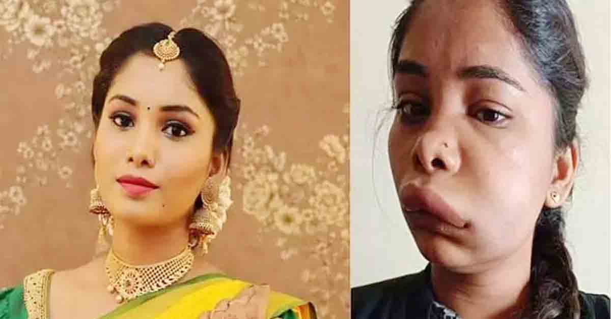 Swathi Sathish: వికటించిన సర్జరీ.. గుర్తుపట్టలేనంతగా మారిపోయిన హీరోయిన్‌!