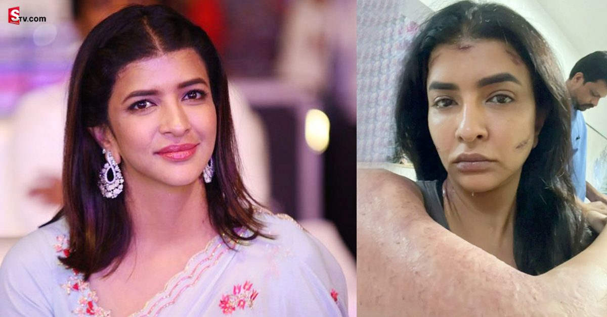 Lakshmi Manchu: మంచు లక్ష్మికి గాయాలు! కారణం ఏమిటంటే?