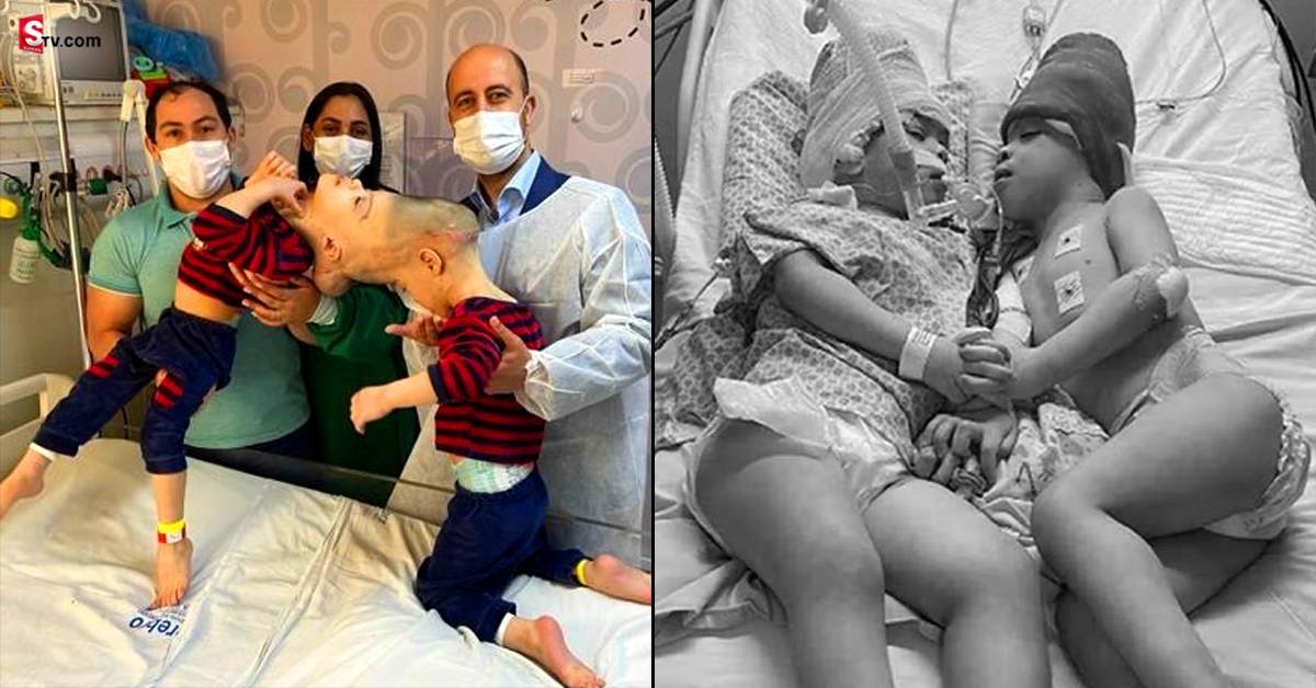 Conjoined Twins: అత్యంత అరుదైన ఆపరేషన్‌.. ఇద్దర్నీ వేరు చేయటానికి 27 గంటలు పట్టింది!