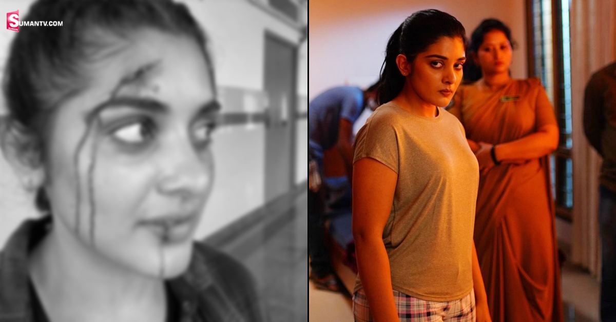 Nivetha Thomas: ముఖం మీద గాయాలతో నివేదా థామస్.. ఏమైంది?