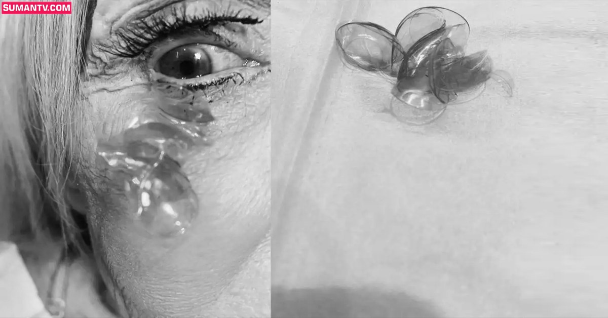Contact Lense: వైరల్‌ వీడియో: మహిళ కంట్లో 23 కాంటాక్ట్‌ లెన్స్‌లు.. డాక్టర్‌ అవ్వాక్‌!
