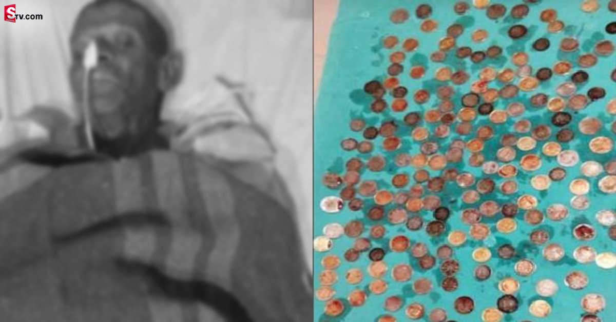 రోగి కడుపులో 187 నాణేలు.. ఖంగుతిన్న వైద్యులు!