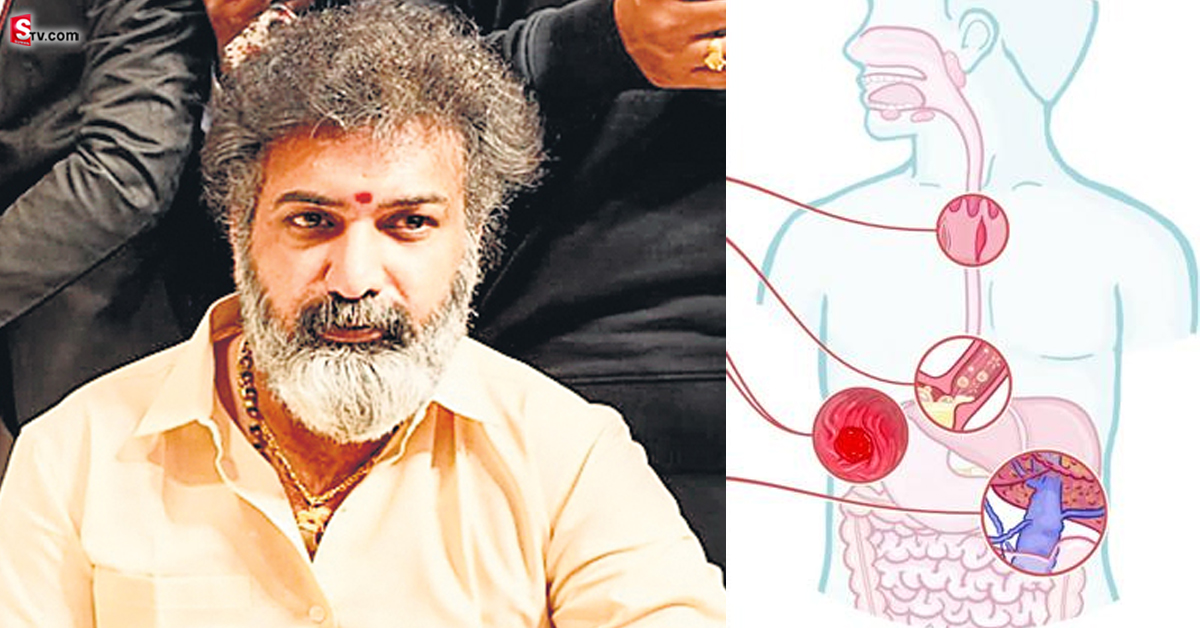 తారకరత్నకు వచ్చిన వ్యాధి మెలెనా.. దీని లక్షణాలు ఎలా ఉంటాయో తెలుసా?