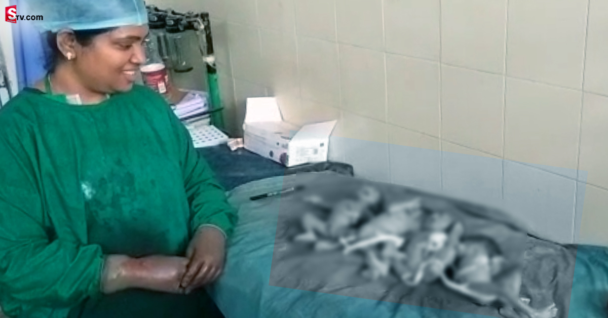 మహిళకు అరుదైన సర్జరీ.. ఒకే కాన్పులో ఏకంగా నలుగురు శిశువుల జననం!