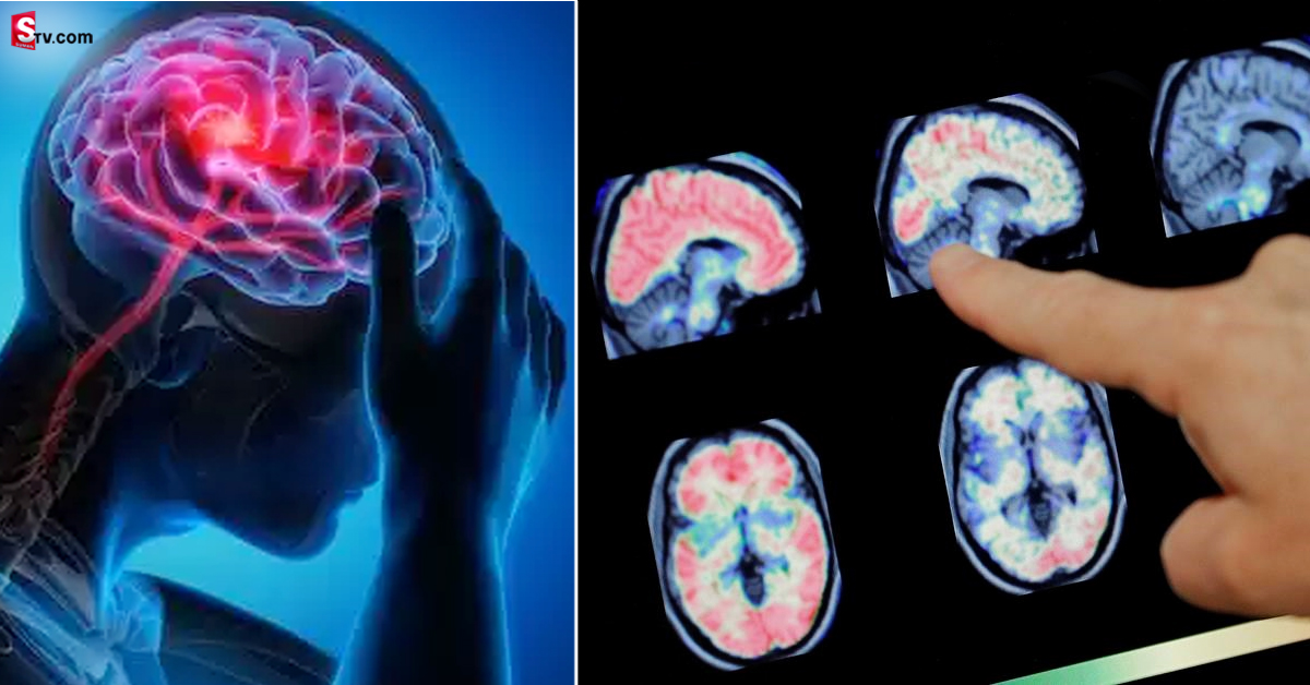 Parkinson Disease: మెదడును శాశ్వతంగా దెబ్బ తీసే వ్యాధి.. ఒక్కసారి వస్తే అంతే సంగతులు!
