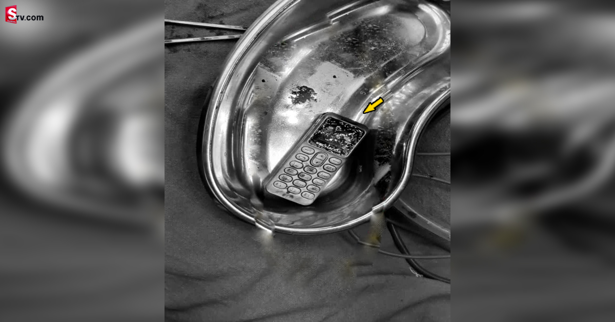 Mobile Phone: సెల్​ఫోన్​ మింగిన యువతి.. అసలు విషయం తెలిసి బిత్తరపోయిన వైద్యులు!