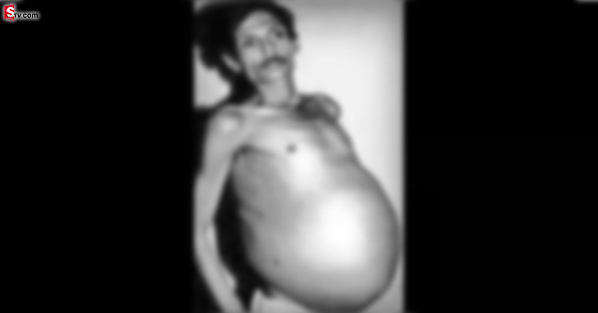 అతడి కడుపులో మరో మనిషి.. 36 ఏళ్లుగా లోపలే ఉంటూ..