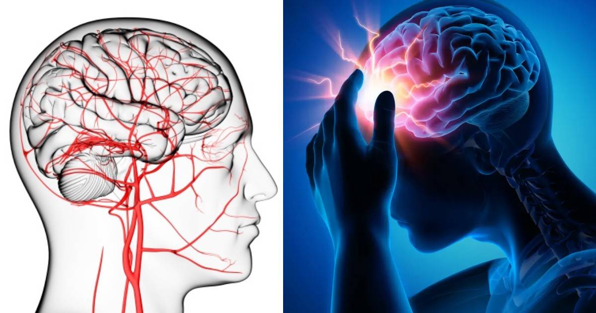 స్ట్రోక్ అంటే ఏంటి, వచ్చే ముందు ఎలాంటి ప్రమాదకర సంకేతాలు ఉంటాయి